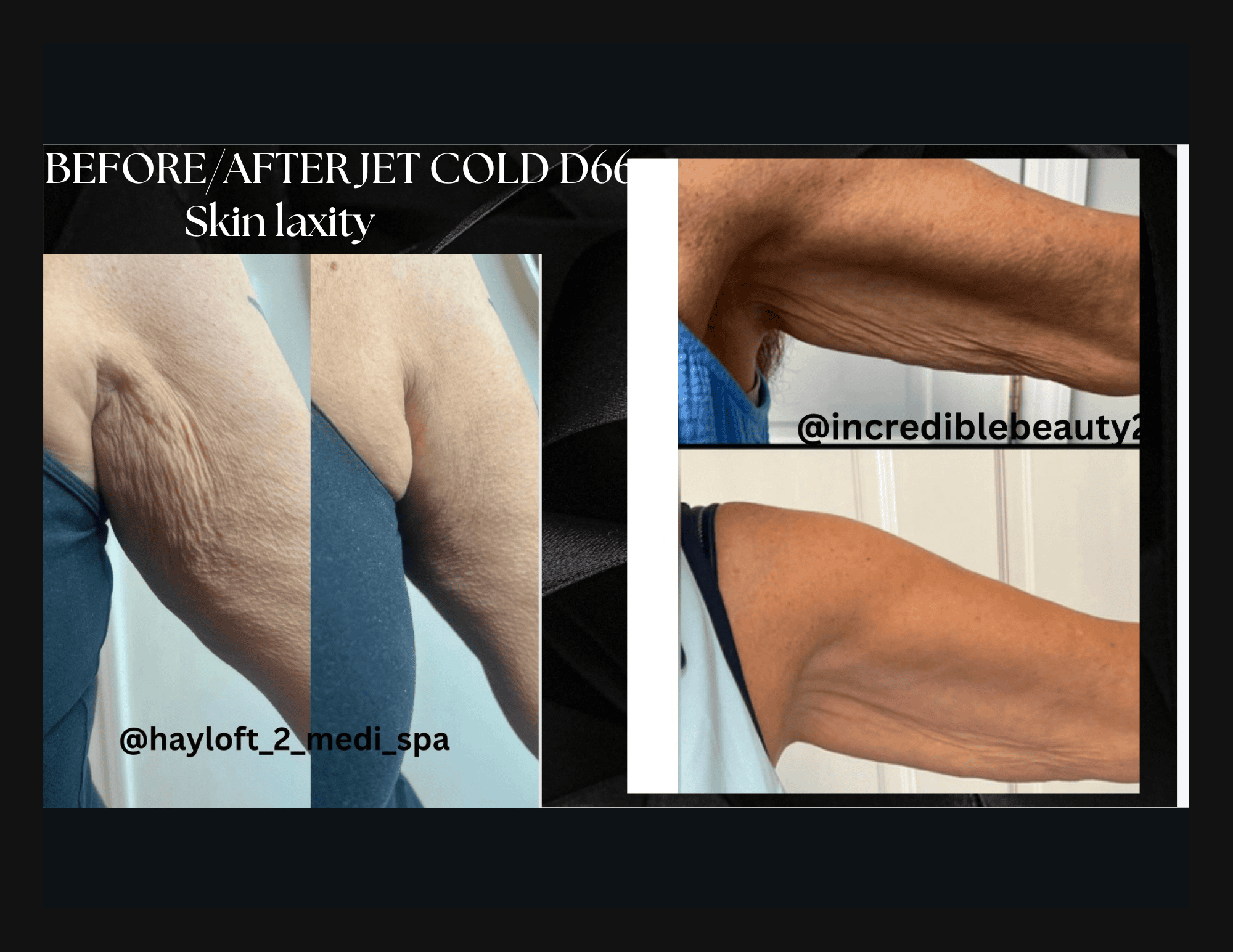 Skin laxity improvement before and after jet cold D66 treatment at Wellness Drip, MA.